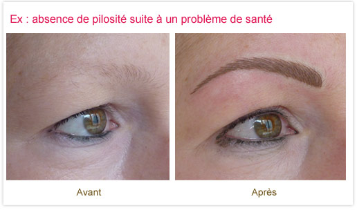 Dermopigmentation réparatrice : re-création d'une ligne de sourcils