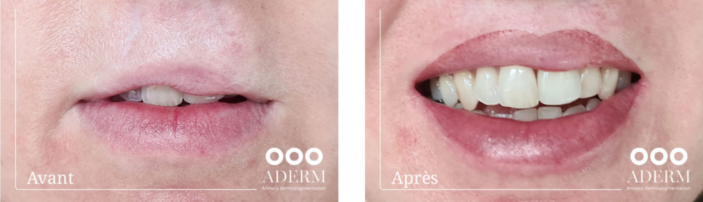 Dermopigmentation réparatrice des lèvres