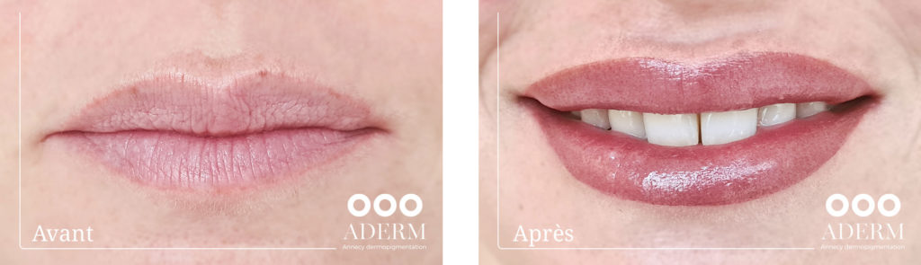 Dermopigmentation - Centre ADERM - Annecy