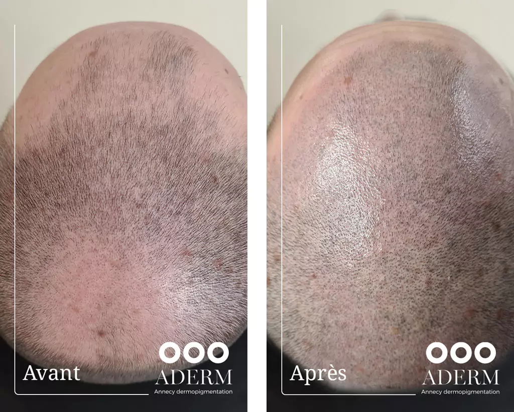 Alopétie - Tricopigmentation -Annecy